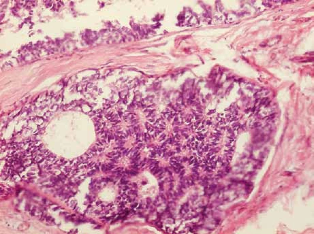 Histologický vzhled duktálního karcinomu in situ, grade 2, steroidní receptory oba vysoce pozitivní, který byl průkazný jak v centru invazivního karcinomu, tak i na jeho periferii.