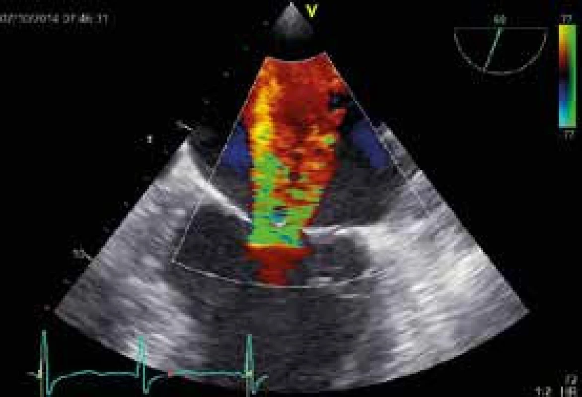 Transezofageální echokardiografie (TEE) s významnou mitrální regurgitací široce do dilatované levé síně (4. stupeň ze 4).