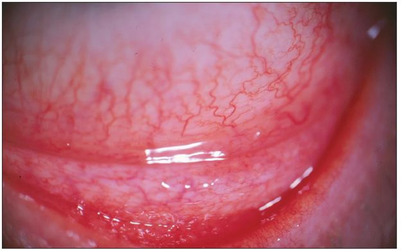 Pacient č. 5: střední klinický nález – výrazné zduření dolního fornixu s folikuly dolního tarzu doprovázené vinutostí cév bulbární spojivky a hyperémií