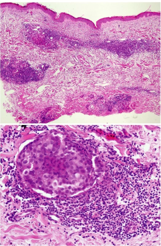Metastázy adenokarcinomu prsu šířící se lymfatickými cévami (a – přehled, HE, 40x, b – detail, HE, 400x).