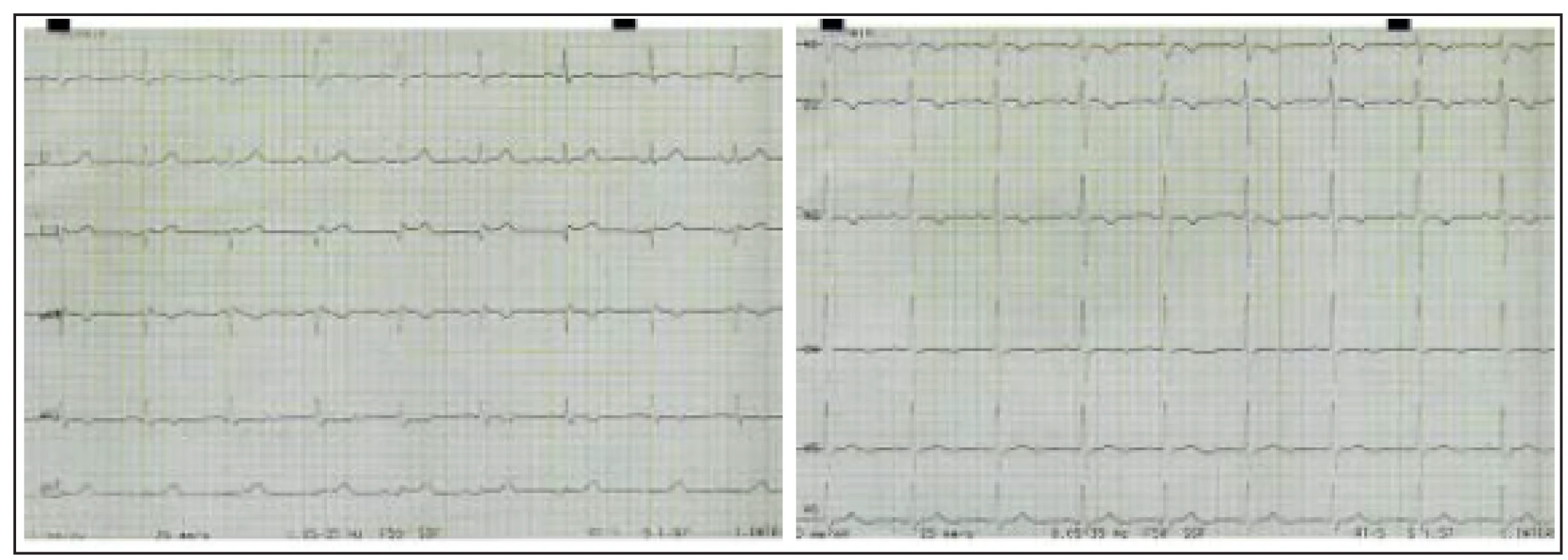 Elektrokardiografický záznam pacientky z 12. 2. 2003 při prvním kardiologickém vyšetření pro námahové bolesti na hrudi. Ve V1–V3 je negativní vlna T, v aVL vlna T ploše negativní, ve V4 oploštělá.