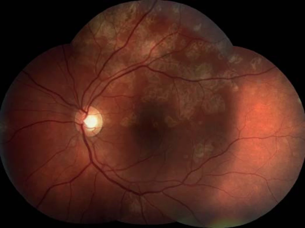 Levé oko. Původní aktivní ložiska na sítnici se postupně ohraničují a částečně pigmentují.