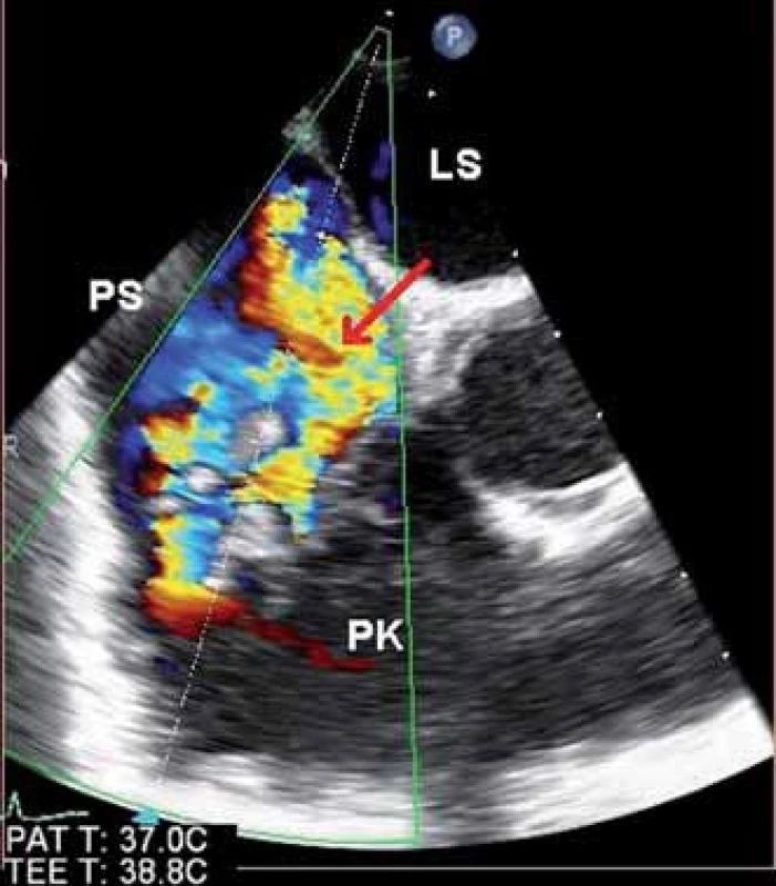 Snímek z jícnového echokardiografického vyšetření, barevné dopplerovské vyšetření zobrazující regurgitační jet (červená šipka) na trikuspidální chlopni – projekce na pravostranné srdeční oddíly. 
PS – pravá síň, PK – pravá komora,  LS – levá síň