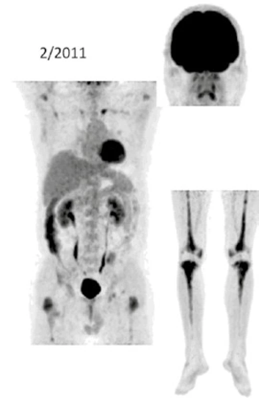 FDG-PET/CT zobrazení pacienta v roce 2011 před zahájením léčby anakinrou
Při low-dose CT zobrazení, které bylo součástí PET/CT vyšetření, byla patrná četná osteosklerotická ložiska ve skeletu zvláště v dolních končetinách se zvýšenou akumulací &lt;sup&gt;18&lt;/sup&gt;F-fluorodeoxyglukózy (FDG)