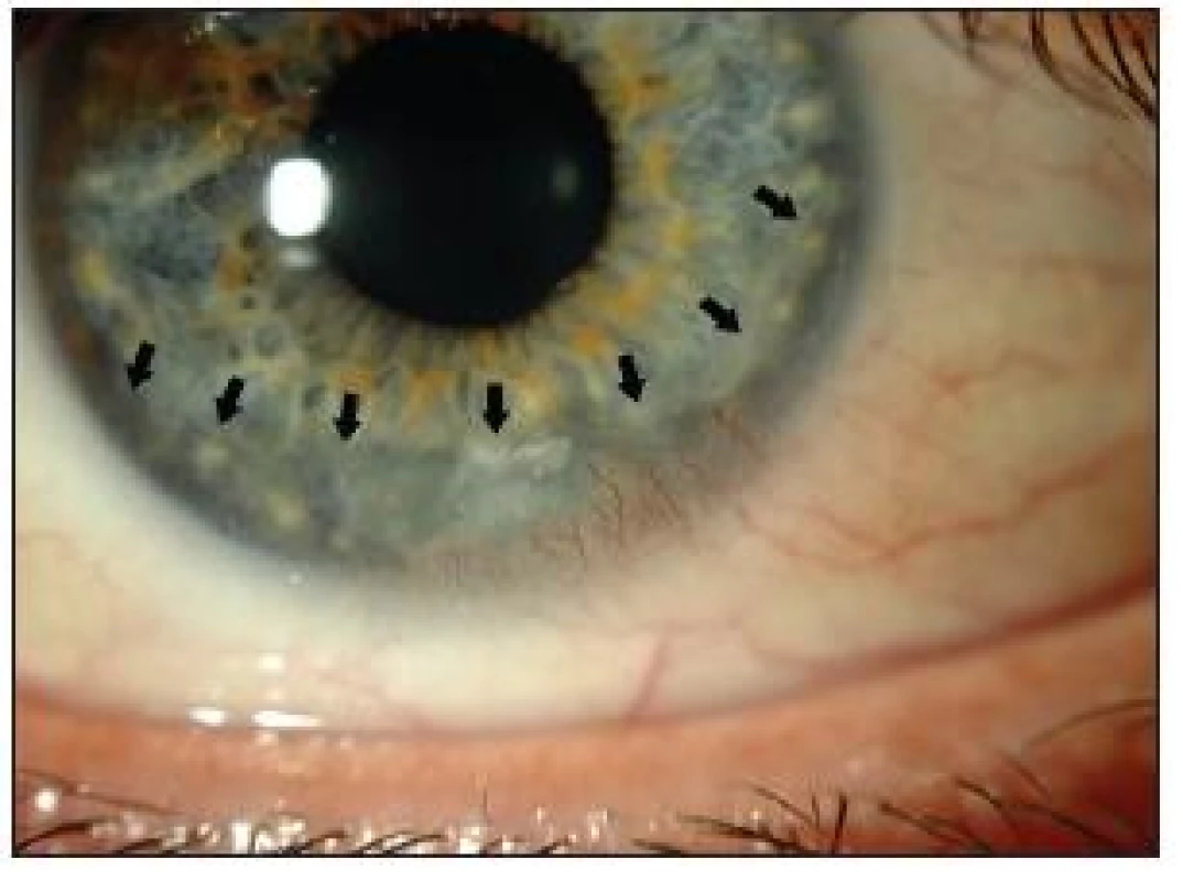 Foto předního segmentu pravého oka. Šipky vyznačují rozsah rohovkové ulcerace s počínající vaskularizací defektu při expoziční keratopatii