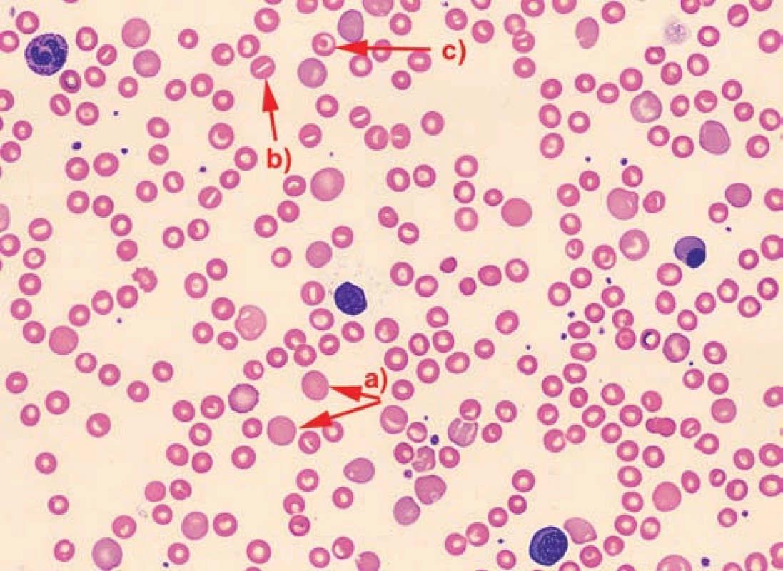 Nátěr periferní krve pacienta č. 3 – anizocytóza, polychromazie (a), ojedinělé stomatocyty (b) a terčovité erytrocyty (c).
Fig. 2. The No. 3 patient’s blood smear – anisocytosis, polychromasia (a), isolated stomatocytes (b) and target erythrocytes (c).