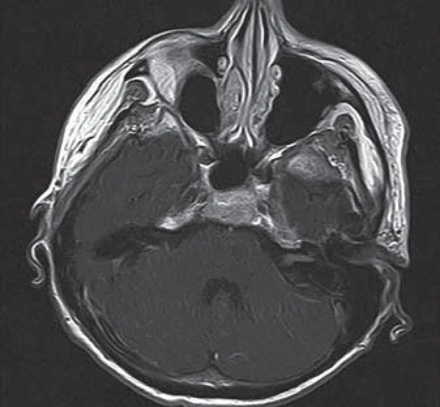 Vybrané MR skeny kontrastního vyšetření hlavy a krční míchy s enhancementem leptomening a VIII. hlavového nervu (šipka).