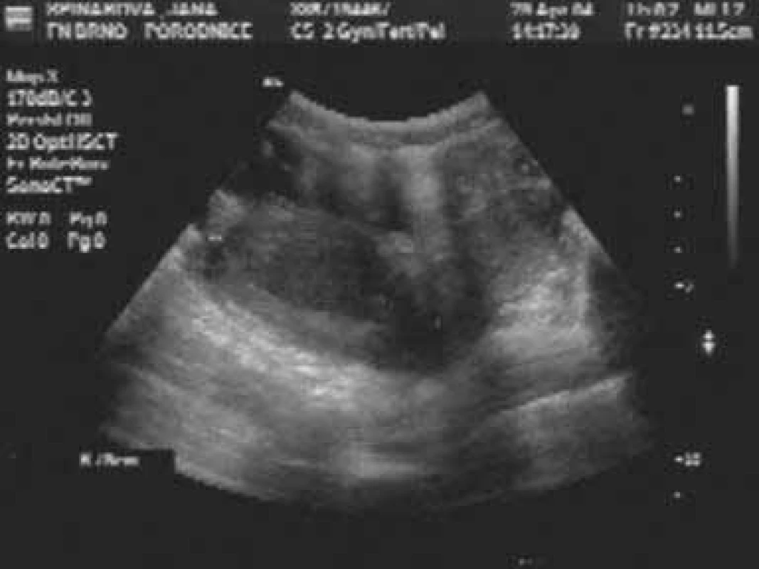 Ultrazvukové vyšetření: hematometra v rudimentárním rohu děložním vlevo.