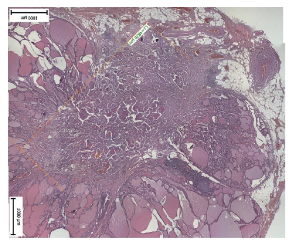 Extrakapsulární prorůstání nádoru<br>
Fig. 3: Extracapsular invasion of tumor cell