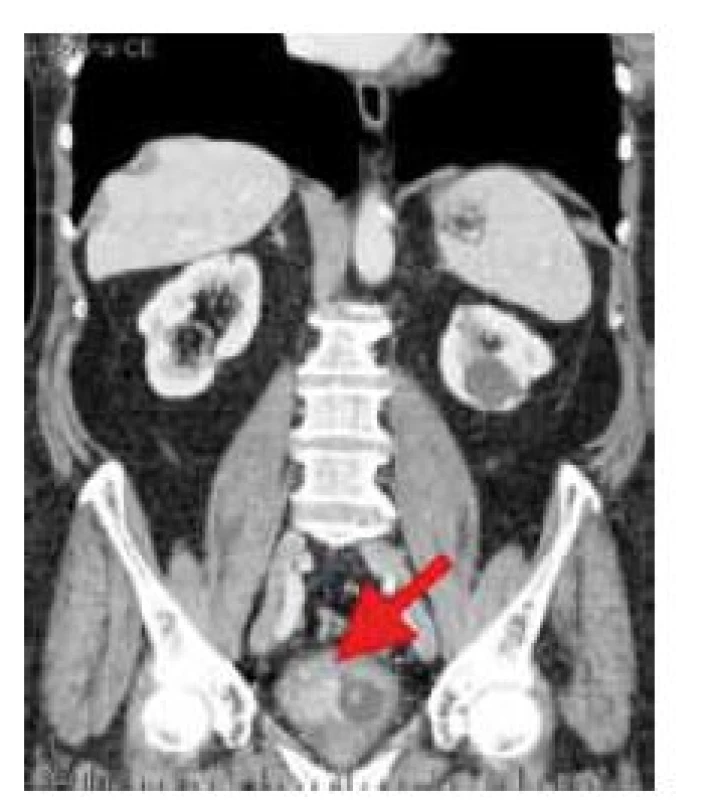 Nádor močového mechúra v obraze počítačovej tomografie (označený šípkou)
Fig. 1. Tumour of the urinary bladder in computer tomography image (arrow)