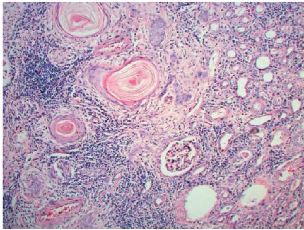 Dlaždicobuněčný karcinom ledvinné pánvičky (100×HE)
Fig. 2. Squamous cell carcinoma of the renal pelvis (100×HE)