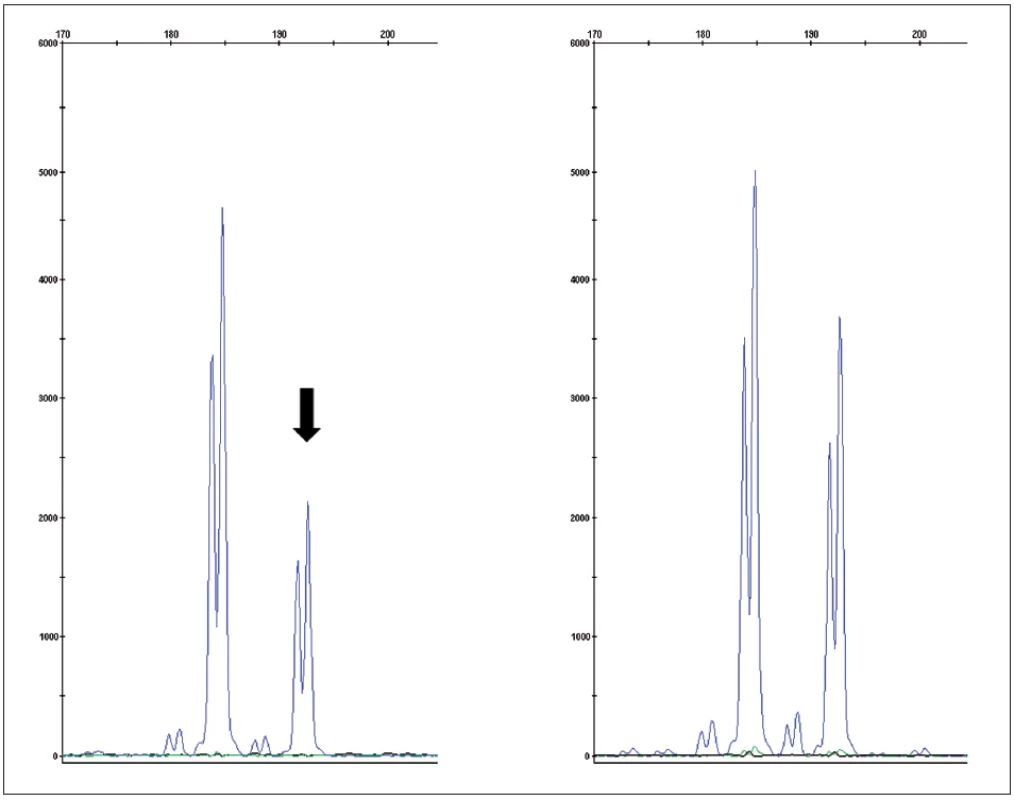 Fragmentační analýza mikrosatelitního markeru D3S1768S potvrzující ztrátu heterozygosity v nádorové tkáni (vlevo) oproti kontrole (zdravá tkáň – vpravo)
Fig. 4. Fragment analysis of microsatelite marker D3S1768S proving loss of heteroyzgosity in tumor tissue (left) compared to control (normal tissue – right)