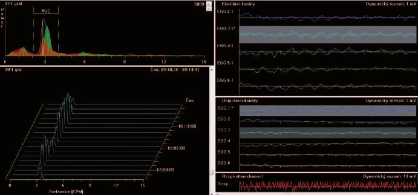 EGG. Vlevo dole dominantní frekvence, vlevo nahoře plocha amplitud, vpravo dole respirační kanál registrující dechové frekvence a pohybové artefakty.
Fig. 3. EGG. Dominant frequency (bottom left), amplitudes (on top left), respiratory channel registrating respiratory frequency and potion artefacts (bottom right).