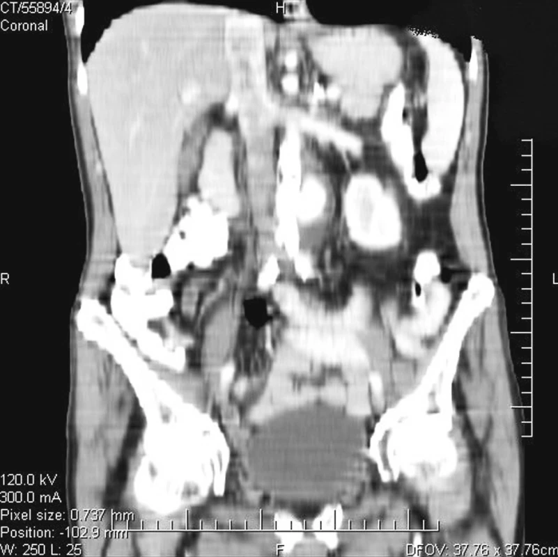 Mykotické aneuryzma abdominální aorty – CT obraz (rekonstrukce)
Fig. 1. Mycotic aneurysm of the abdominal aorta – CT view (reconstruction)