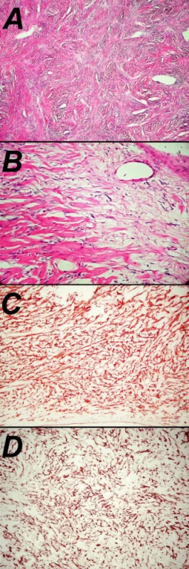 Mikrofotografia obrovského solitárneho tumoru (A – farbenie hematoxilín – eozín, 100x; B – farbenie hematoxilín – eozín 400x; C – imunohistochemická pozitivita CD34, 200x; D – imunohistochemická pozitivita bcl2, 400x)
Fig. 4. Micro. Photography of the large solitary tumor (A –hematoxyllin-eosin staining, enlargement100x; B – hematoxylin- eosin staining, enlargement 400x; C – immunohistochemical positivity CD34, 200x; D – immunohistochemical positivity bcl2, 400x)
