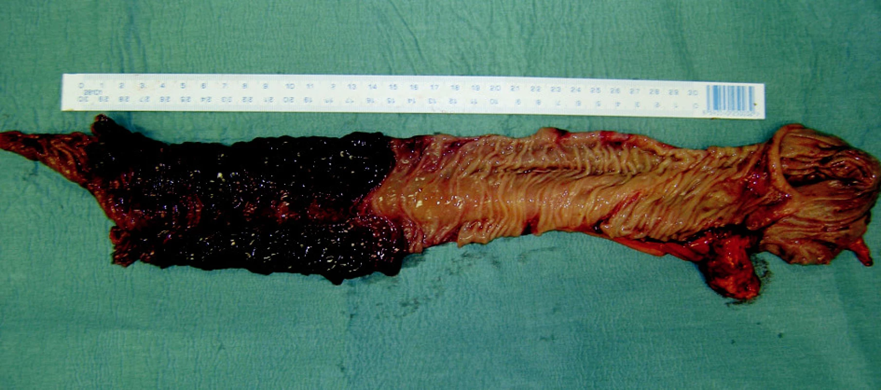 Stopkatý tumor distálního ilea – maligní melanom
Fig. 4. The stem tumor of the distal ileum – melanoma malignum