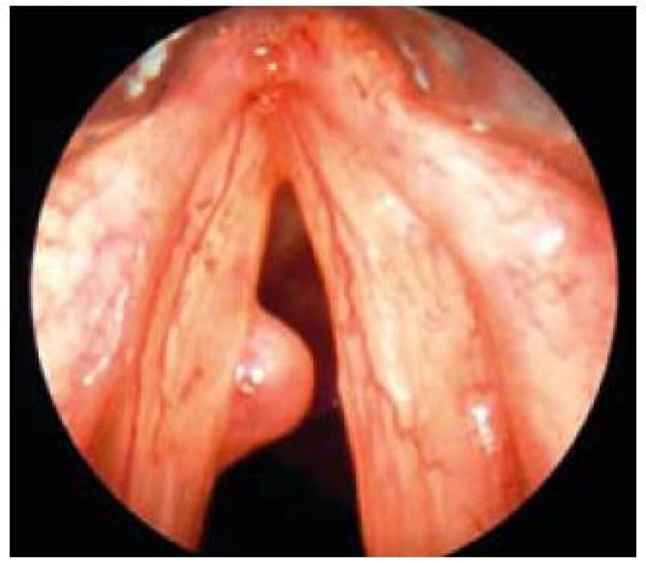 Polyp levé hlasivky.
Fig. 7. Polyp of the left vocal cord.