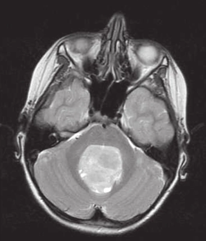 MRI mozgu, T1 vážený obraz v sagitálnej rovine (vľavo) a T2 vážený obraz v transverzálnej rovine (vpravo). Meduloblastóm vermis cerebella s tlakom na IV. mozgovú komoru, iniciálny nález. [09.11.2012]