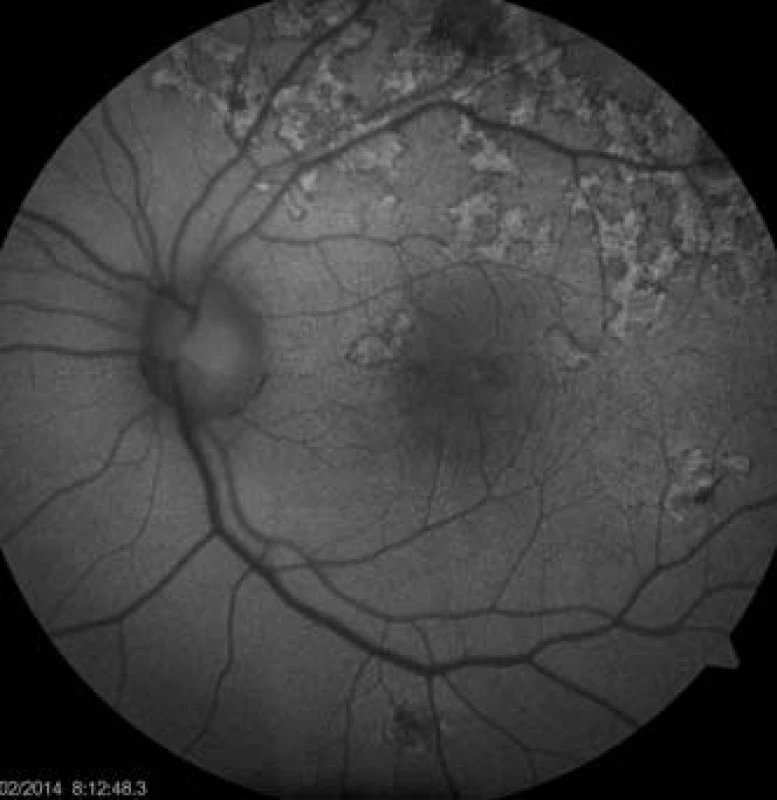 Auto-fluorescenční fotografie očního pozadí oka levého. Ložiska atrofie RPE, dysgrupace pigmentu v postižených oblastech.