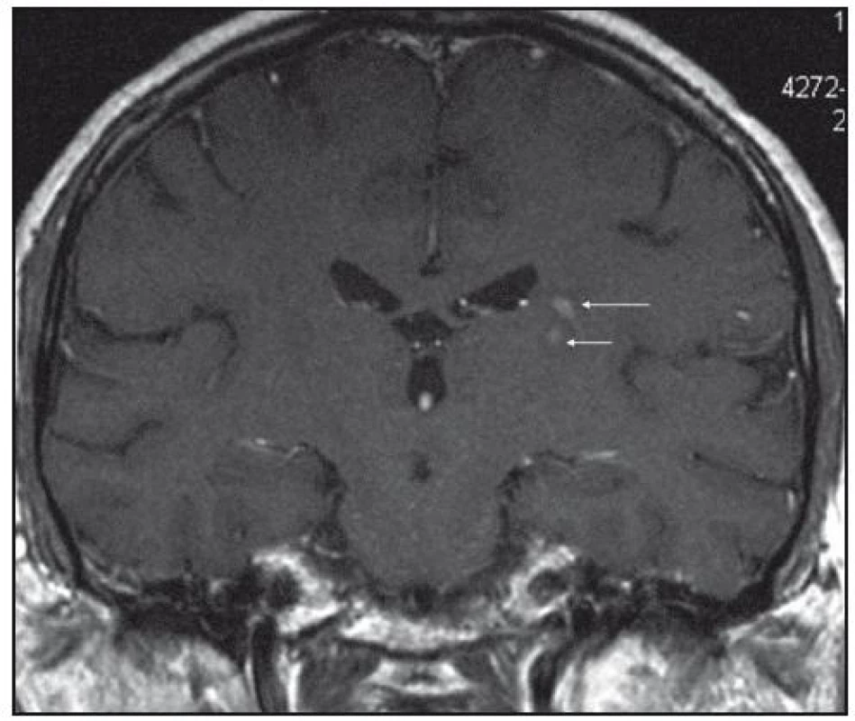 MR mozku v roce 2008, zobrazení zadního raménka kapsuly interny vlevo. Všechna ložiska mají stejné chování, nativně jsou patrná v sekvenci FLAIR, T2, PD jako necharakteristická hypersignální, postkontrastně dochází k sycení jejich centra. Koronární řez T1 váženého postkontrastního obrazu.