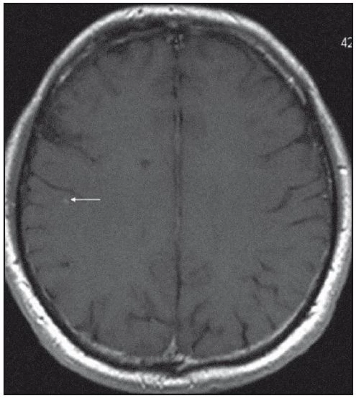 MR mozku v roce 2007: tečkovité ložisko subkortikálně F- P vpravo (byly shledány na dalších řezech vícečetné difuzně).