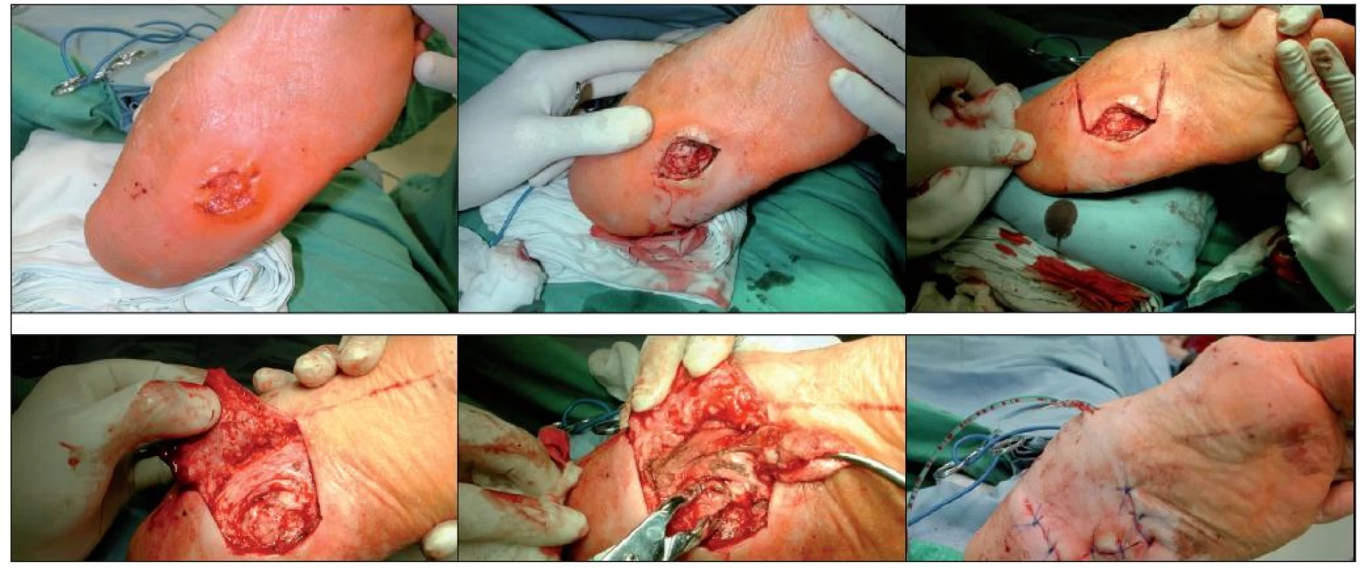 Chirurgická ulcerektomie