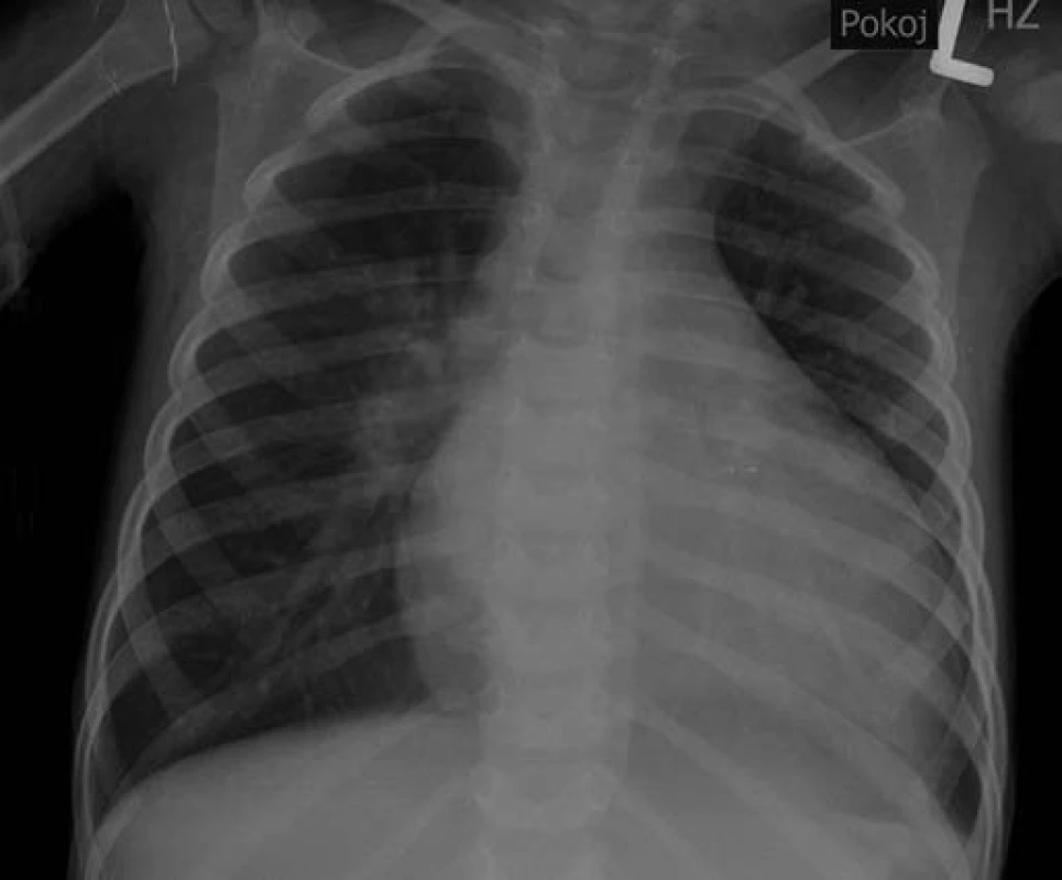 Rtg snímek srdce a plic s dilatací srdečního stínu u pacienta č. 3.
Fig. 4. X-ray of heart and lungs with dilatation of the heart shadow in the patient No. 3.