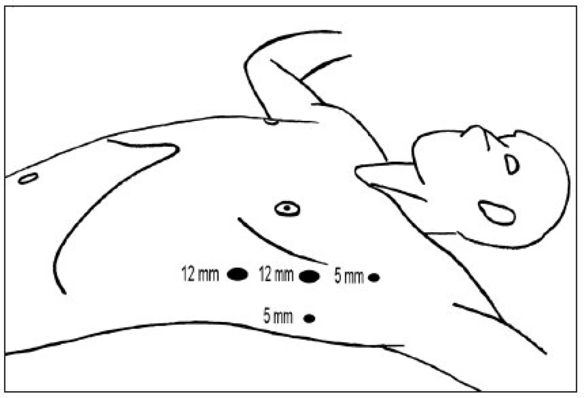 Rozmístění portů při torakoskopické tymektomii v přední a zadní axilární linii
Fig. 2. Thoracoscopic thymectomy port site positions in anterior and posterior axillary line
