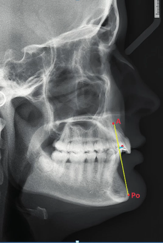 Poloha dolního řezáku (incize) k linii A-Po (archiv kliniky zubního lékařství LF UPOL) Bod A – nejzadnější bod na přední kontuře horního alveolárního výběžku, uložen asi 2 mm před apexy horních řezáků. Bod Po (Pogonion) – bod nejvíce vpředu na symfýze mandibuly