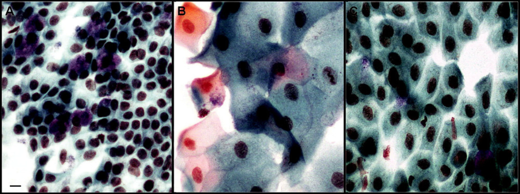 Otisková cytologie spojivky: vzorek zdravé spojivky – A, vzorek pacienta před – B, a vzorek pacienta po aplikaci AS – očních kapek – C