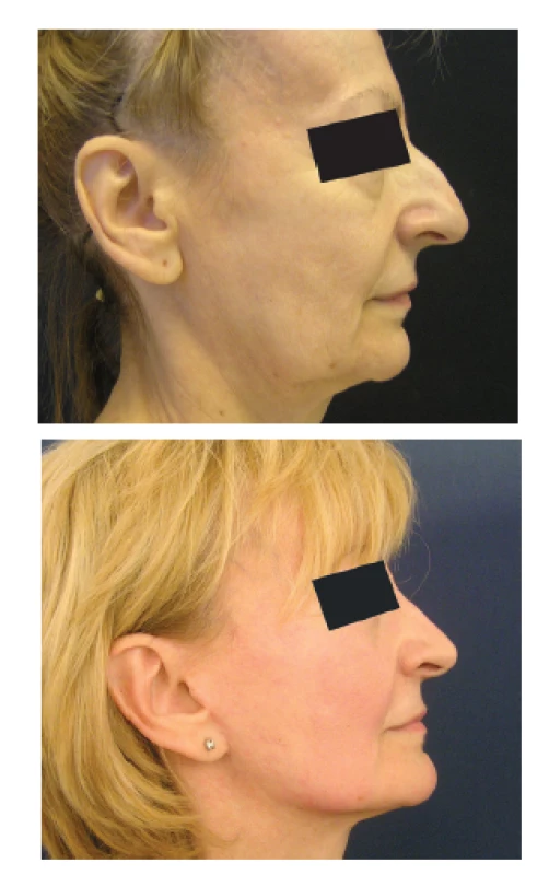 Rinoplastika u starší ženy po faceliftingu
Fig. 4: Rhinoplasty after facelift surgery in an older female