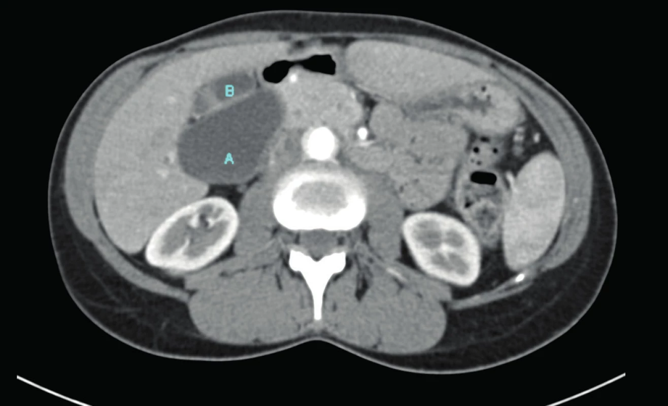 CT břicha v axiální rovině (A – cysta ductus choledochus, B – žlučník)
Fig. 1: Axial abdominal CT image (A – choledochal cyst, B – gall bladder)
