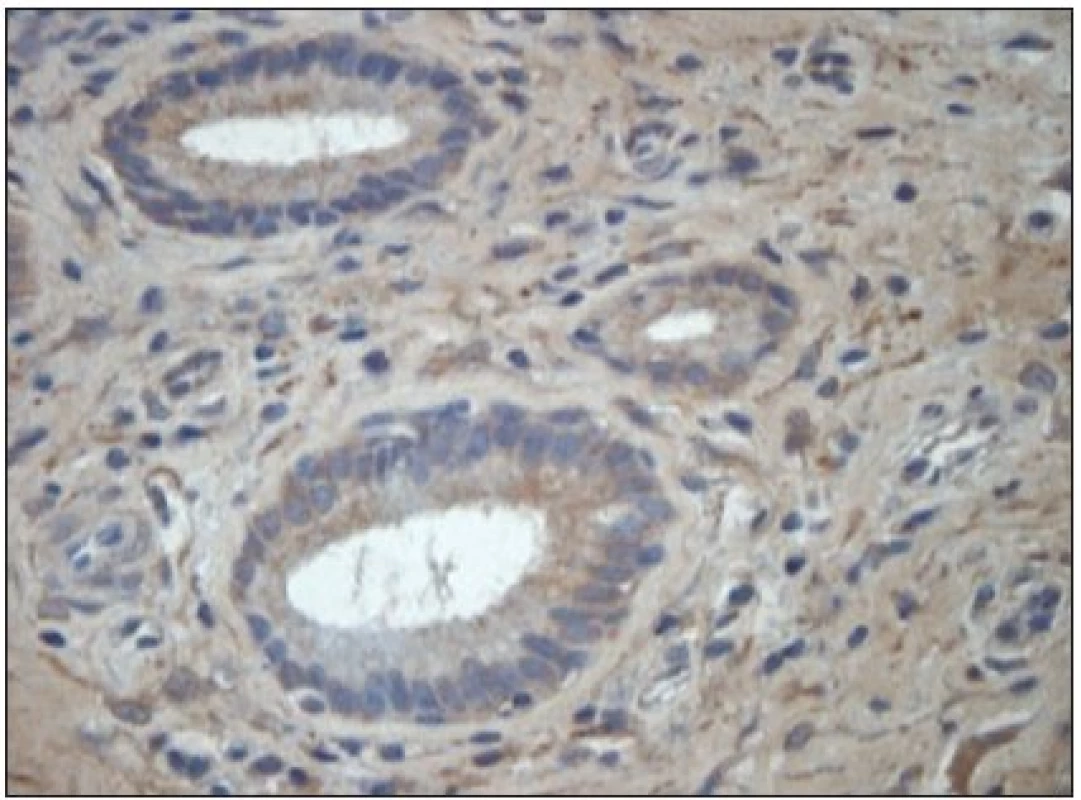 HBD-3 v cytoplazmě buněk vývodů žláz klinicky zdravé nosní sliznice. Imunoperoxidázová reakce (DAB). Dobarveno hematoxylinem. Obj. 63x.