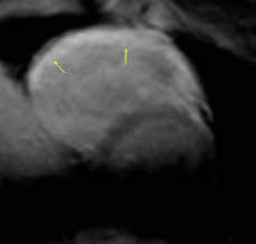 Difuzní transmurální pozdní sycení kontrastní látkou (LGE) celé volné stěny pravé komory (žluté šipky) u pokročilého stadia arytmogenní kardiomyopatie pravé komory; projekce na krátkou osu levé komory