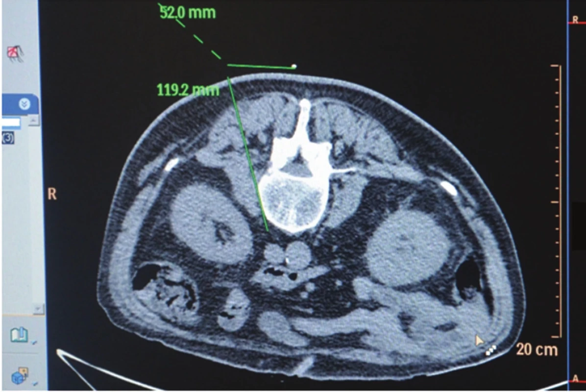 CT navigácia u pravostrannej chemickej LS (úroveň L3)
Fig. 3. CT guided right-side chemical lumbar sympathectomy (level L3)