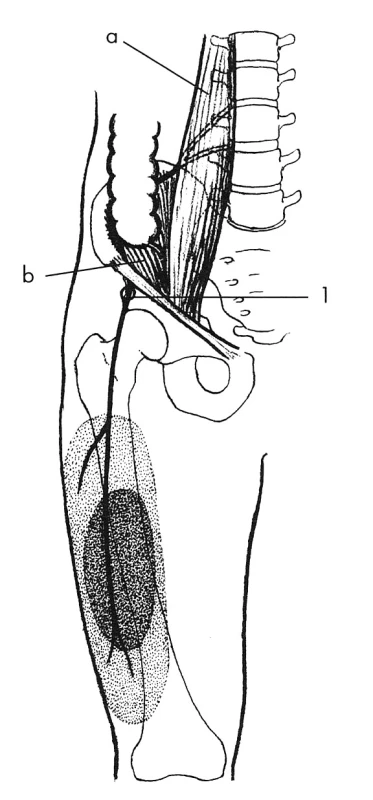 N. cutaneus femoris lateralis
Nejčastější lokalizace lézí nervů je při průstupu pod tříselným vazem; 1 – svaly: a – m. psoas major, b – m. iliacus. Vytečkovaná oblast vyznačuje poruchu čití.