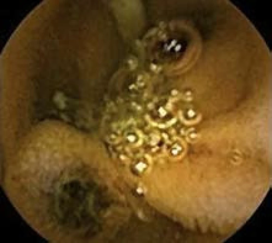 Polyp jejuna, kapslová enteroskopie.
Fig. 3. Polyp in jejunum, capsulle enteroscopy.