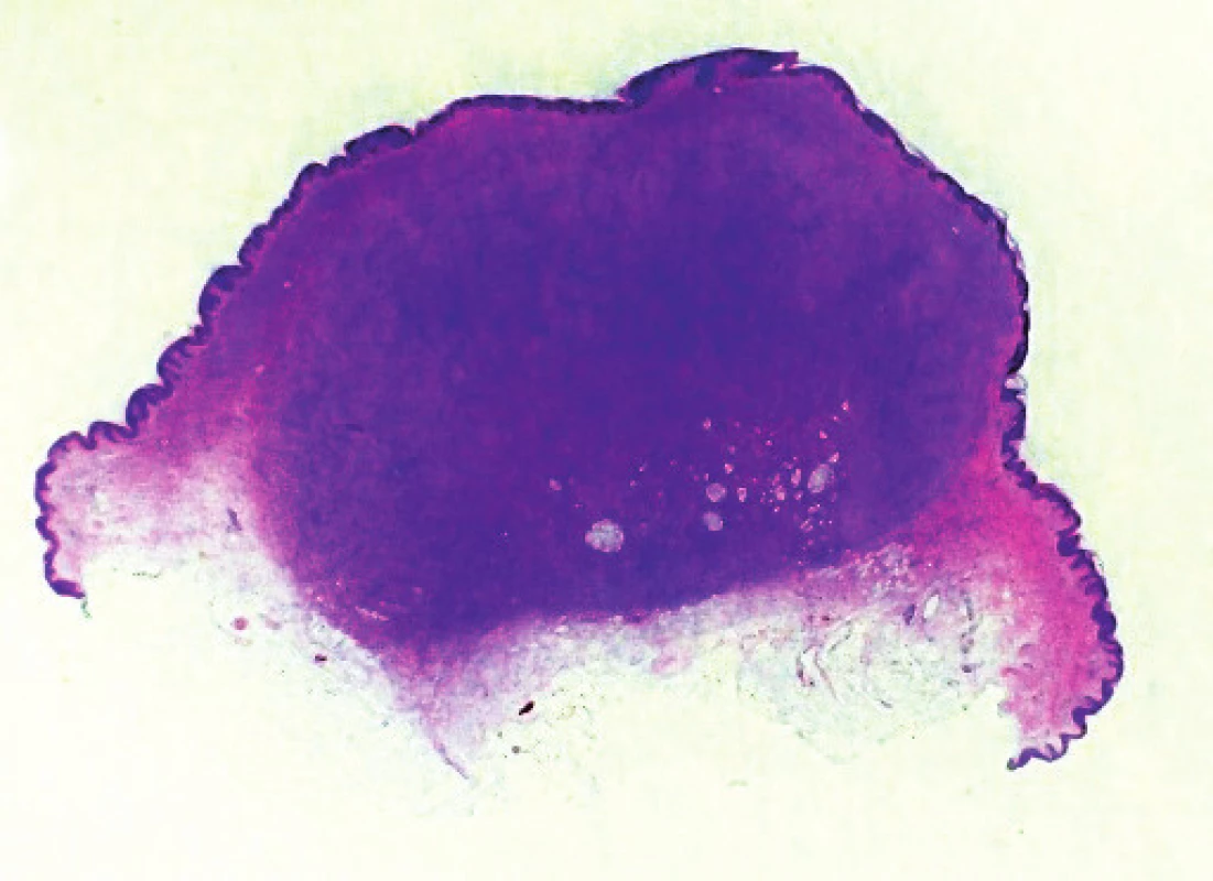Přehledný snímek excidovaného nodulárního útvaru, hematoxylin-eosin