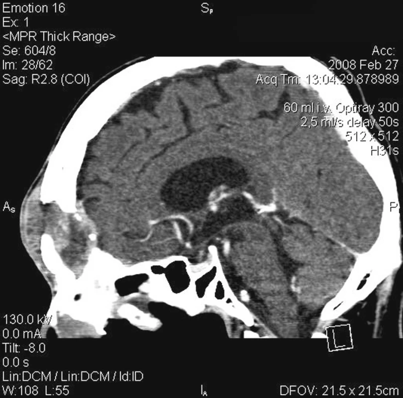 Defekt přední a zadní stěny čelní dutiny, měkkotkáňová tumorózní masa deformující čelní krajinu, odtlačující periost frontální kosti a infiltrující tvrdou mozkovou plenu. (CT vyš. sagitální projekce).