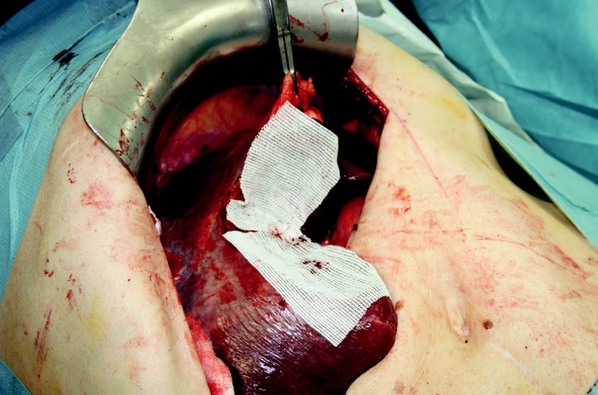 Extraanatomická resekce jater s překrytím resekčních ploch
Obr. 3. Extraanatomic resection, surfaces covered with Traumacel TAF