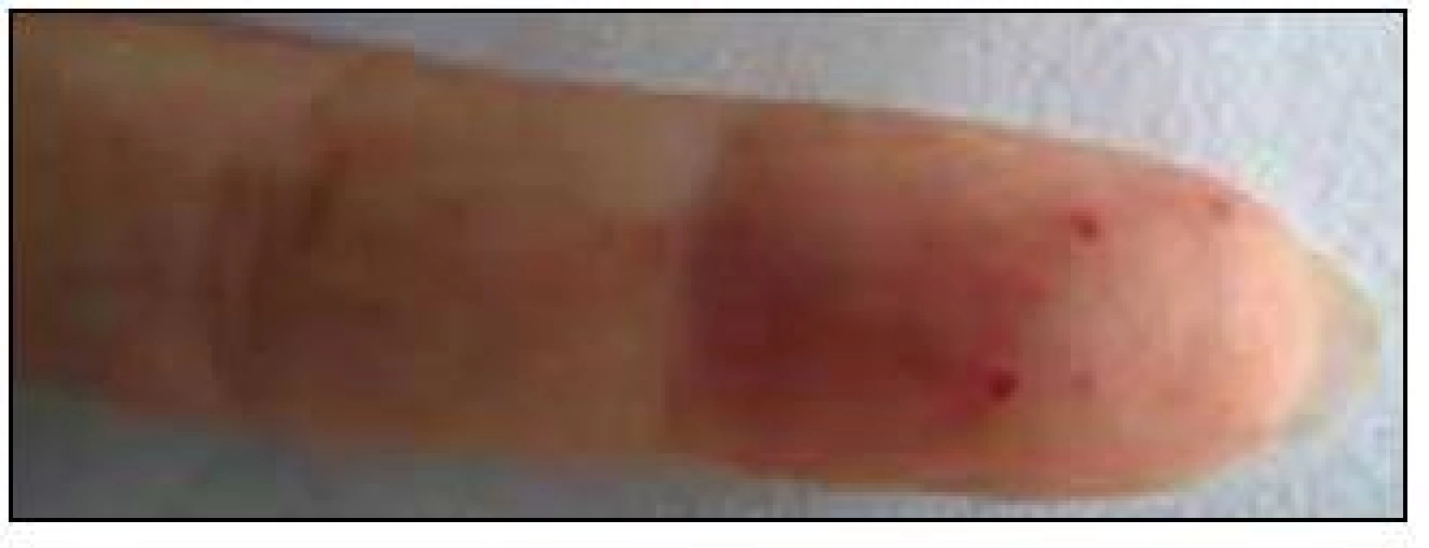 Prst pacienty s typickými kožními teleangiektaziemi.