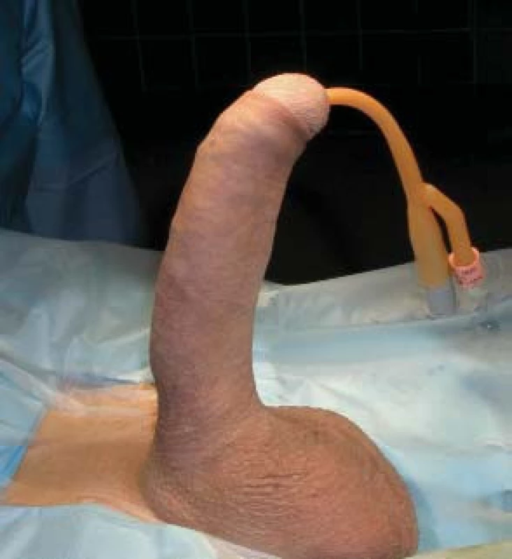 Korekce Peyronieho onemocnění prostřednictvím samotné inflatabilní penilní protézy (do 25°). Narovnávání pokračuje s používáním.
A - před operací , B - po operaci.