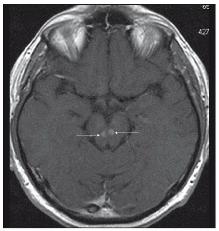 MR mozku v roce 2007: po 18 měsících od předchozího se objevují nová ložiska mozku, postkontrastně se sytící centrum a cirkulární jemný lem kolaterálního edému – v mesencephalon 2 (T1 vážený obraz po aplikaci kontrastní látky, transverzální řez).