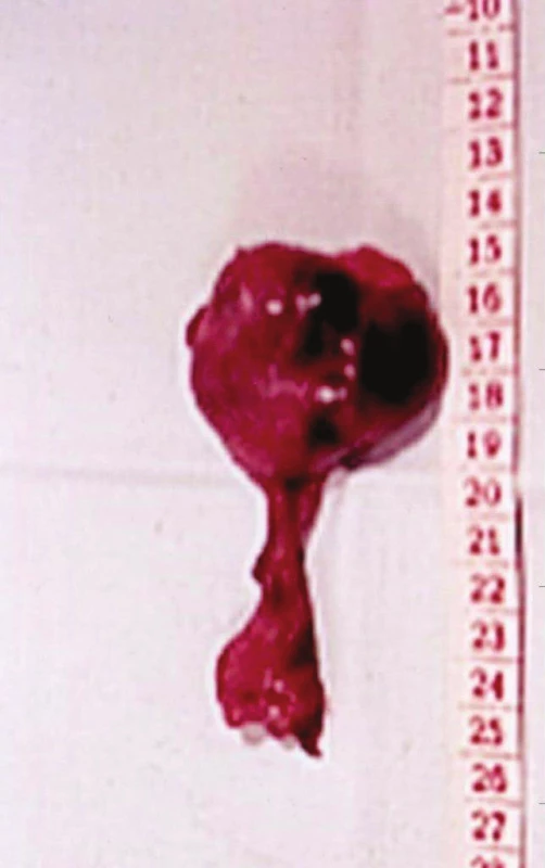 Trombozovaný bulbus a pahýl VSM – příčina sukcesivní PE, stav po operaci varixů
Fig. 7: Thrombosed bulb of GSV – the cause of pulmonary embolism, status after crossectomy