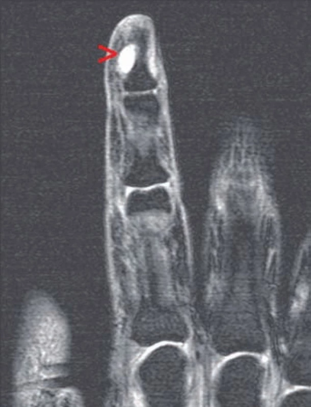 MRI vyšetření (T2 - vážený obraz) – tumor viditelný jako hyhypersignální (bílé) ložisko označené šipkou