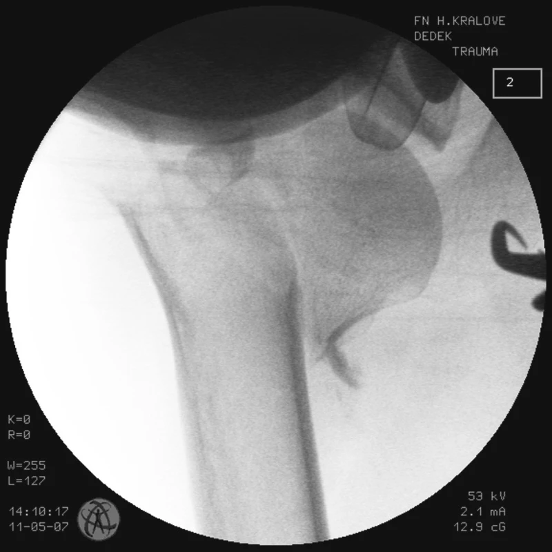 RTG obraz dislokované zlomeniny proximálního humeru u pacienta č. 2
Fig. 4. X-ray view of the dislocated proximal humeral fracture in a patient No. 2