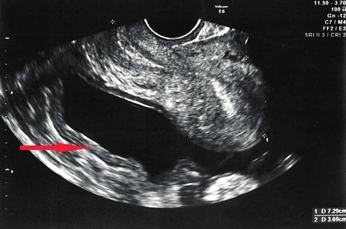 Ultrazvukový snímek malé pánve: šipka ukazuje na ztluštění peritonea