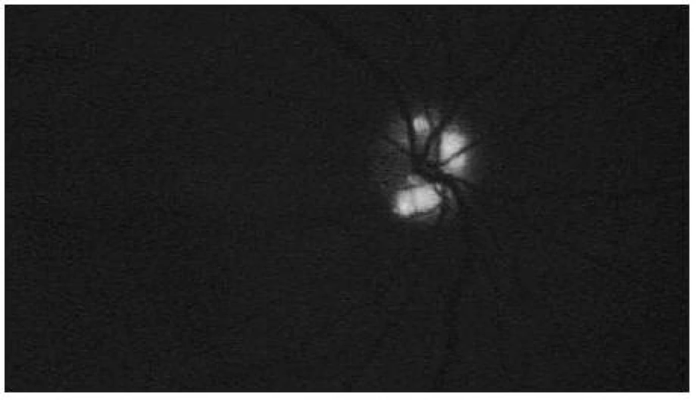 Autofluorescencia drúz u nášho pacienta, pravé oko, vyšetrenie realizované pri kontrole
