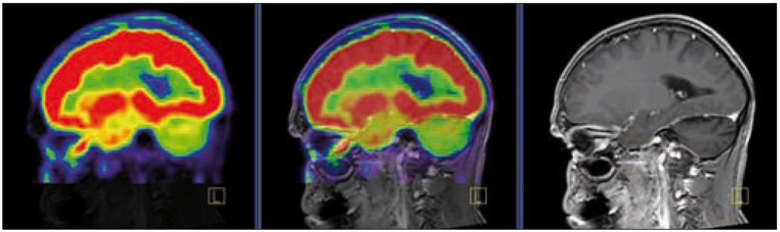 PET – low dose CT mozku. Snížená akumulace fluorodeoxyglukózy v oblasti cerebella, sagitální projekce atrofické změny cerebella v CT zobrazení.