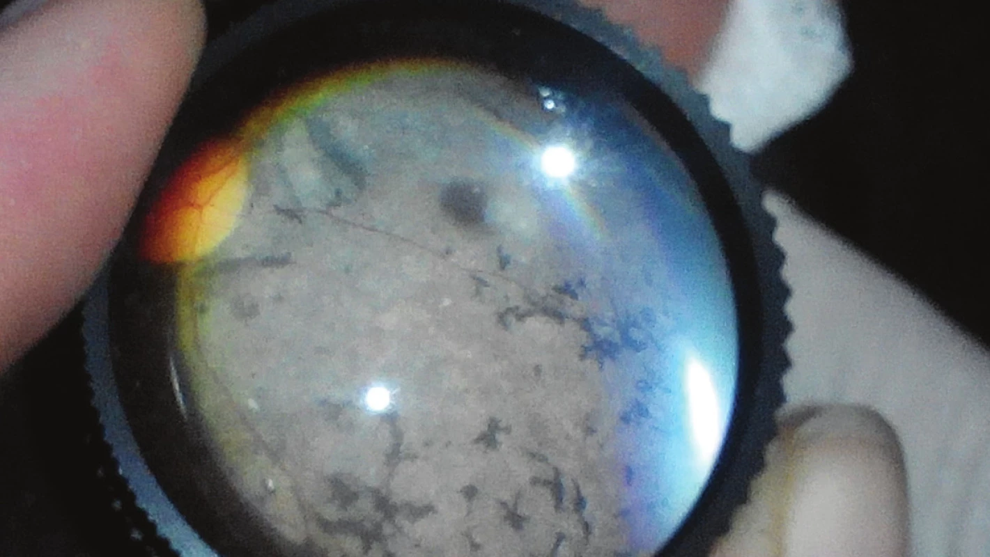 Detail očného pozadia urobeného pomocou Volkovej šošovky a smartfónu u pacienta
s Usherovým syndrómom